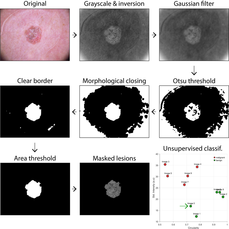Skin lesion classifier preview